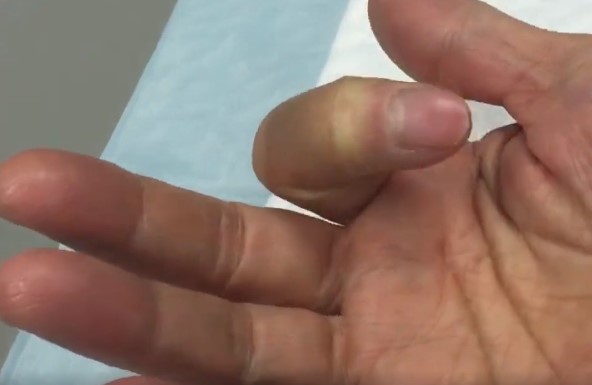 手指無法伸直是比較嚴重的彈弓手症狀表現